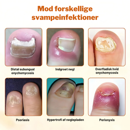 FungiFix™ – Avanceret Svampedræbende Negleplejespray